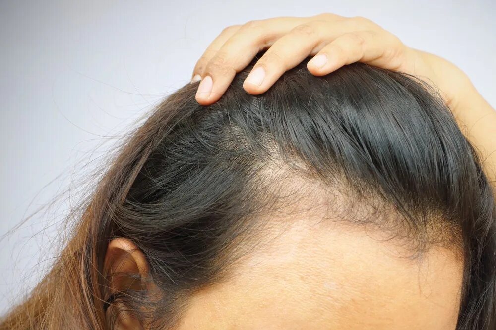 Гнёздная (очаговая алопеция). Очаговая алопеция (alopecia Areata). Лоб корень