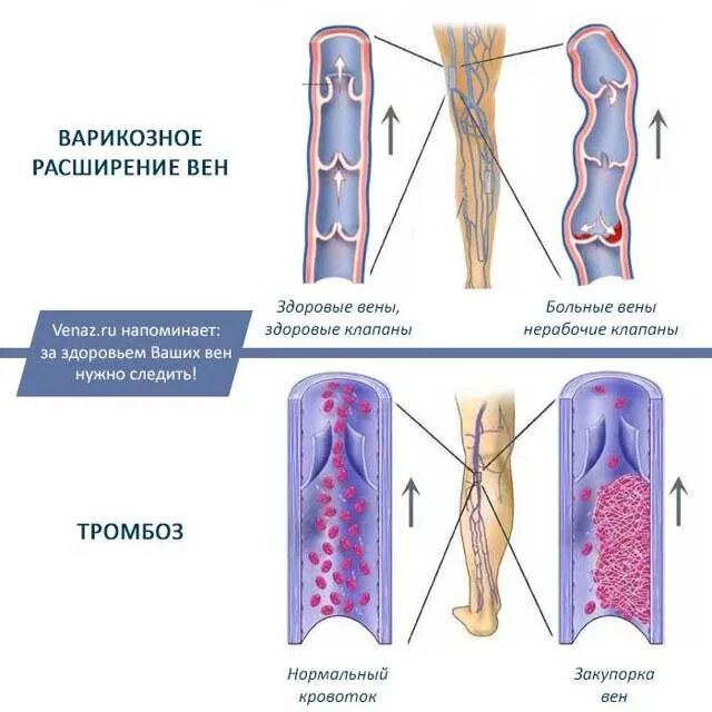 Чем отличается тромб