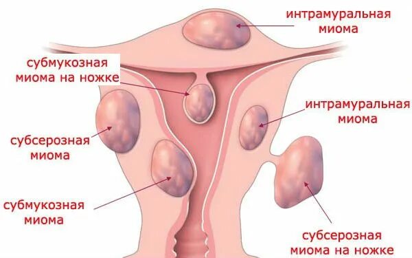 Лейомиома матки что это. Многоузловая форма миомы матки. Мелкоузловая фибромиома матки.