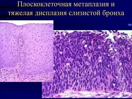 Плоскоклеточная метаплазия матки что это