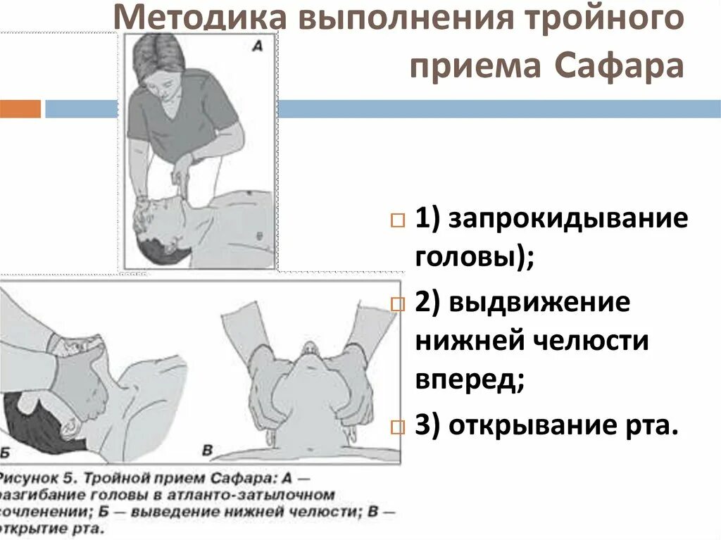 Тройной прием алгоритм. СЛР тройной прием Сафара. Методика выполнения тройного приема Сафара. Восстановление проходимости дыхательных путей прием Сафара.