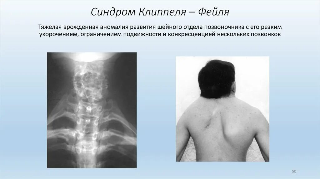 Аномалии развития позвоночника. Аномалия Клиппеля-Фейля. Синдром Клиппеля-Фейля. Синдром Клиппеля Фейля Шпренгеля. Болезнь Клиппеля Фейля.