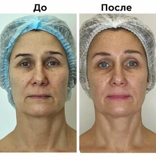 Лпж массаж лица отзывы