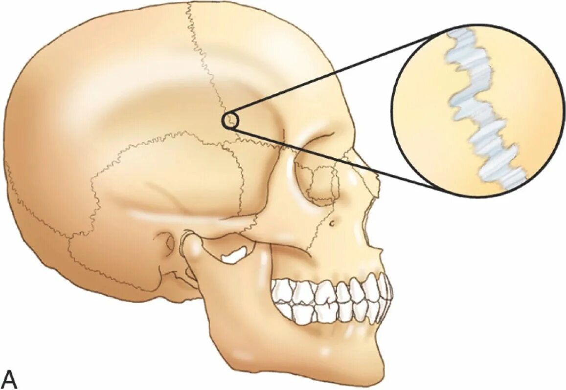 Деформация кости черепа. Sutura черепа. Кости и швы черепа. Сфено сквамозный шов черепа.