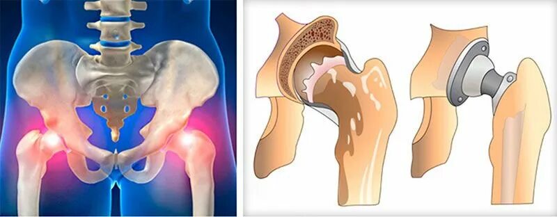 Эндопротезирование ТБС послеоперационный. Реабилитация после эндопротезирования тазобедренного сустава (ТБС). Спейсер тазобедренного сустава. После эндопротезирования ТБС. Эндопротезирование коленного реабилитация после операции