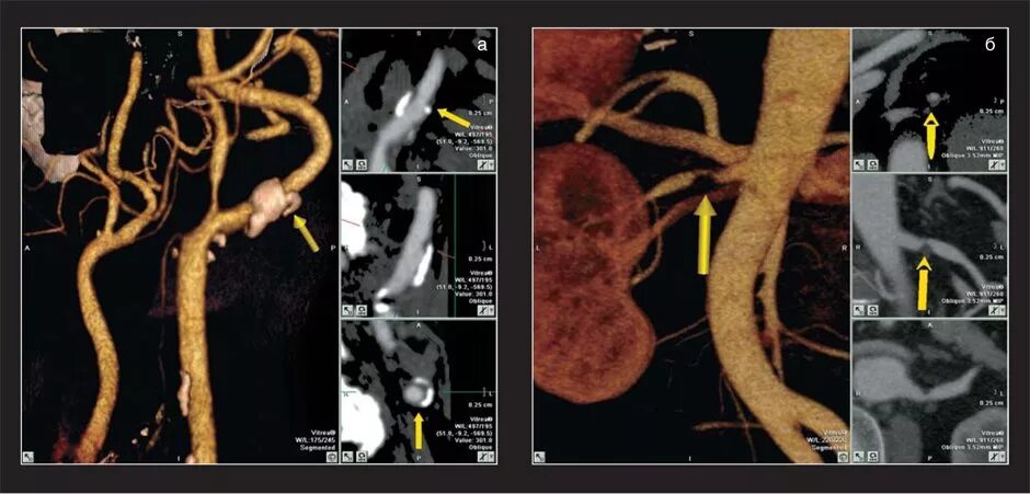 Стеноз устья вса. Кт ангиография сонных артерий. Рестеноз соннойартерии. Брахиоцефальные артерии кт. Атеросклероз сосудов сонных артерий.