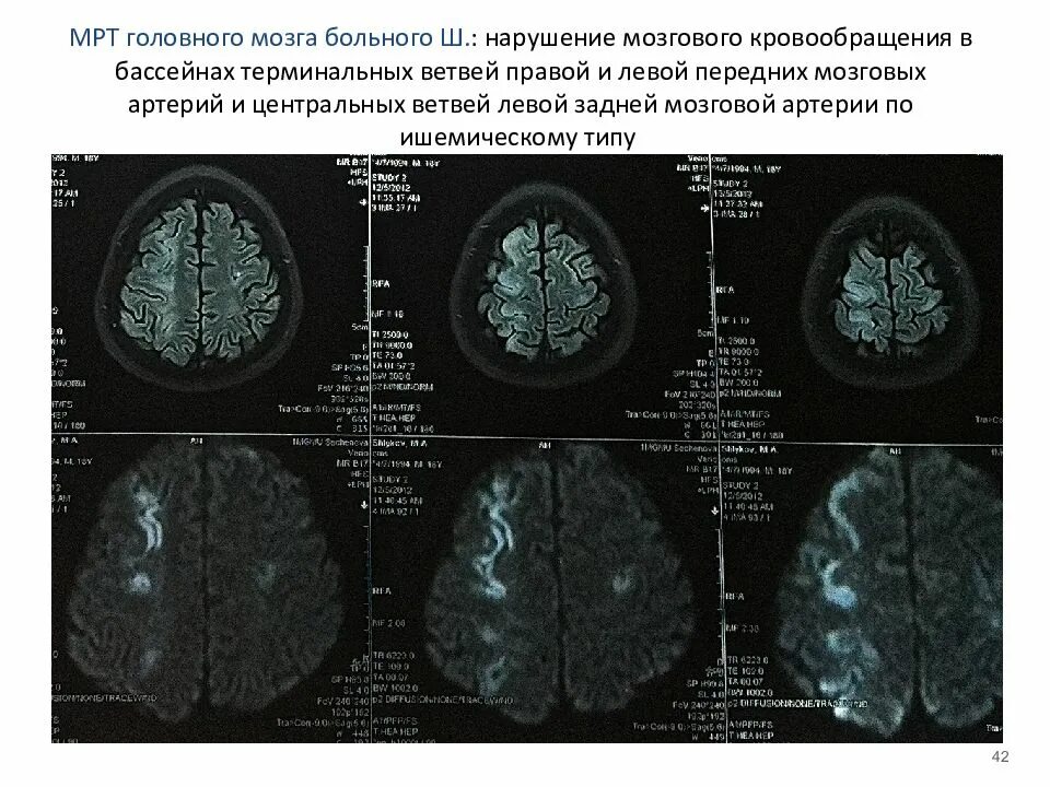 Церебральная микроангиопатия головного мозга мрт. Церебральная микроангиопатия кт. Очаги микроангиопатии на мрт. Очаги микроангиопатии в белом веществе головного мозга. Глиоз полушарий мозга