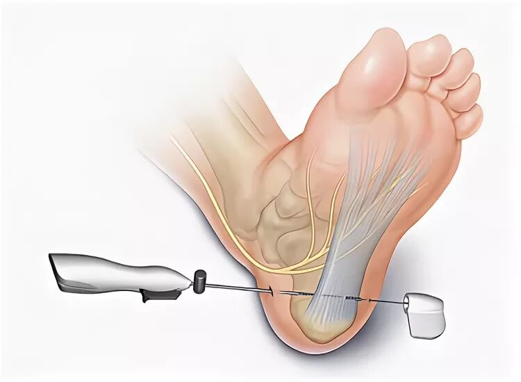 Плантарный фасциит стопы мкб. Апоневроз стопы Леддерхозе. Плантарный фасциит блокада. Стерла пятку
