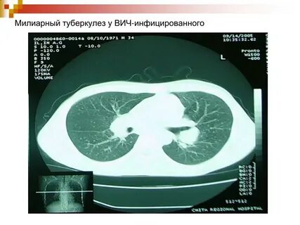 Туберкулез легких при вич