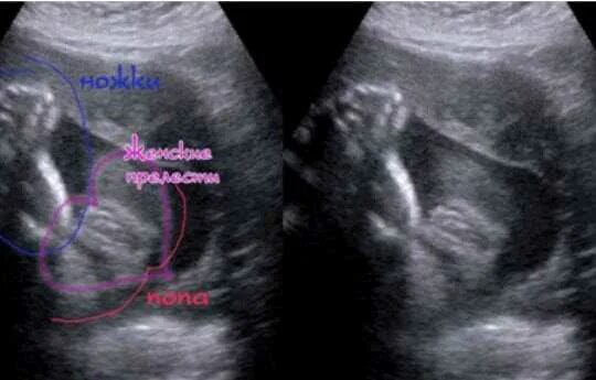 УЗИ девочки и мальчика в 20 недель беременности. УЗИ 20 недель беременности мальчик. УЗИ девочки на 20 неделе беременности. УЗИ на 30 неделе беременности пол мальчик.