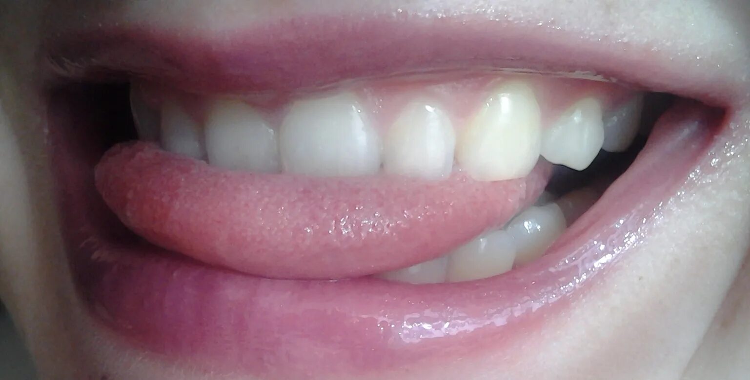 Деминерализация эмали после брекетов. Эндоотбеливание внутриканальное. Серые зубы. Серые зубы. Гингивопластика десневая улыбка.