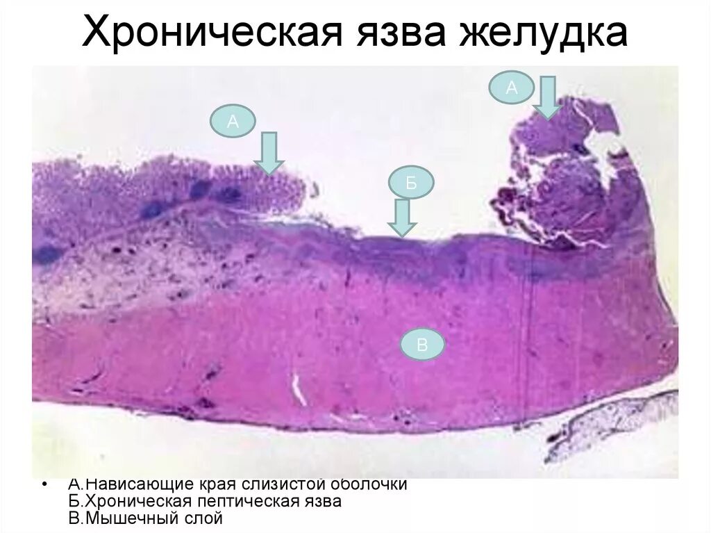 Хроническая язва желудка в фазе обострения микропрепарат. Хроническая язва желудка макропрепарат. Хроническая язва желудка микропрепарат патанатомия. Хроническая язва желудка гистология.