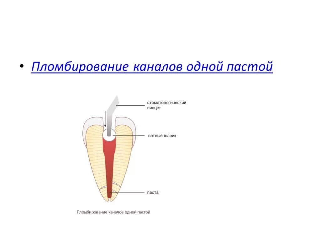 Постоянное пломбирование корневого канала