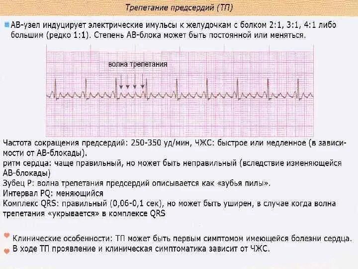 Трепетание предсердий 2 1. Трепетание предсердий 2 к 1 чсс. трепетание предсердий экг чсс 200. трепетание предсердий 2 к 1 на экг. трепетание предсердий классификация на экг.