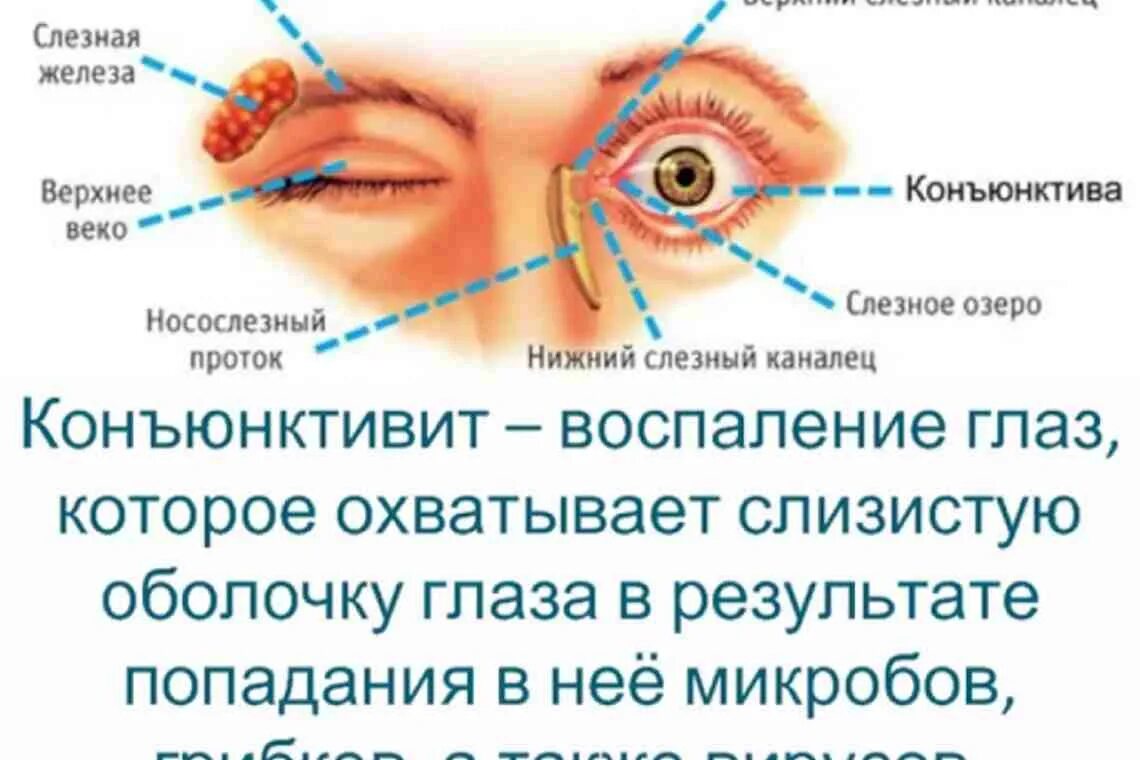 Коньюктивит коньюктивит коньюктивит. Воспалился глаз конъюнктивит. Конъюнктивит и слезятся глаза. Слезная железа нерв