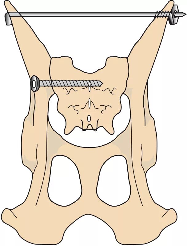 Остеосинтез крестцово-подвздошного сочленения. Крестцово подвздошный сустав у собаки. Крестцовоподвздтшное сочленение. Перелом таза остеосинтез. Крестец подвздошная кость