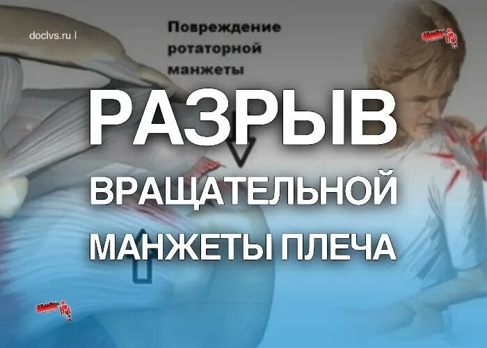 Повреждение мышцы мкб 10. Разрыв надостной мышцы мкб. ротаторная манжета мкб. повреждение вращательной манжеты плеча мкб 10. повреждение ротаторной манжеты плеча мкб 10.