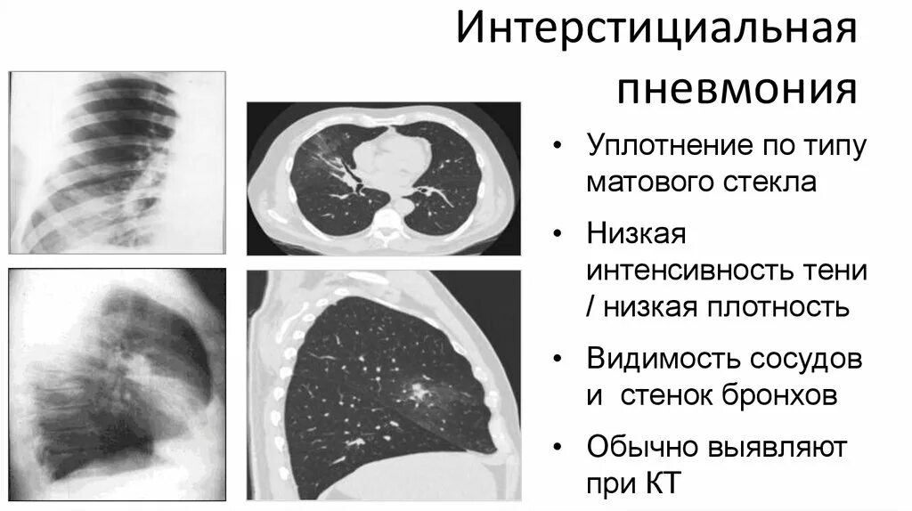 Уплотнения паренхимы по типу
