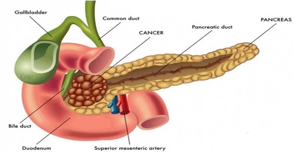 4 стадия поджелудочной железы сколько живут. Ракьподжелудочной железы. Головка поджелудочной железы. Опухоль поджелудочной железы.