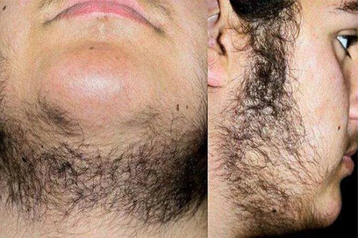 Рост волос на лице у мужчин. Гирсутизм и гипертрихоз. Гирсутизм гирсутизм гормоны. Гирсутизм и вирилизация. Тестостерон гирсутизм.