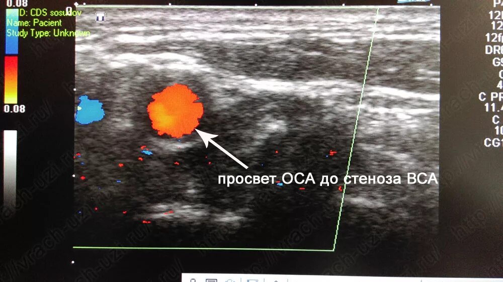 Дуплексное сканирование брахиоцефальных артерий бца ( уздг ). Узи уздг брахиоцефальных сосудов. Цдк триплексное сканирование сосудов брахиоцефального ствола. Уздг дуплексное и триплексное сканирование. Цдк триплексное сканирование сосудов брахиоцефального ствола.
