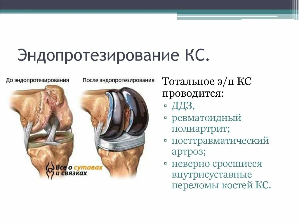 Тотальное эндопротезирование коленного сустава. Эндопротезирование презентация. Тотальное и частичное эндопротезирование. Тотальное и частичное эндопротезирование коленного сустава.