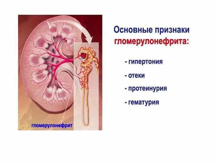 Подострый гломерулонефрит почка. Гломерулонефрит рисунок почки. Острый диффузный гломерулонефрит симптомы. Подострый гломерулонефрит макропрепарат. Хронический диффузный гломерулонефрит