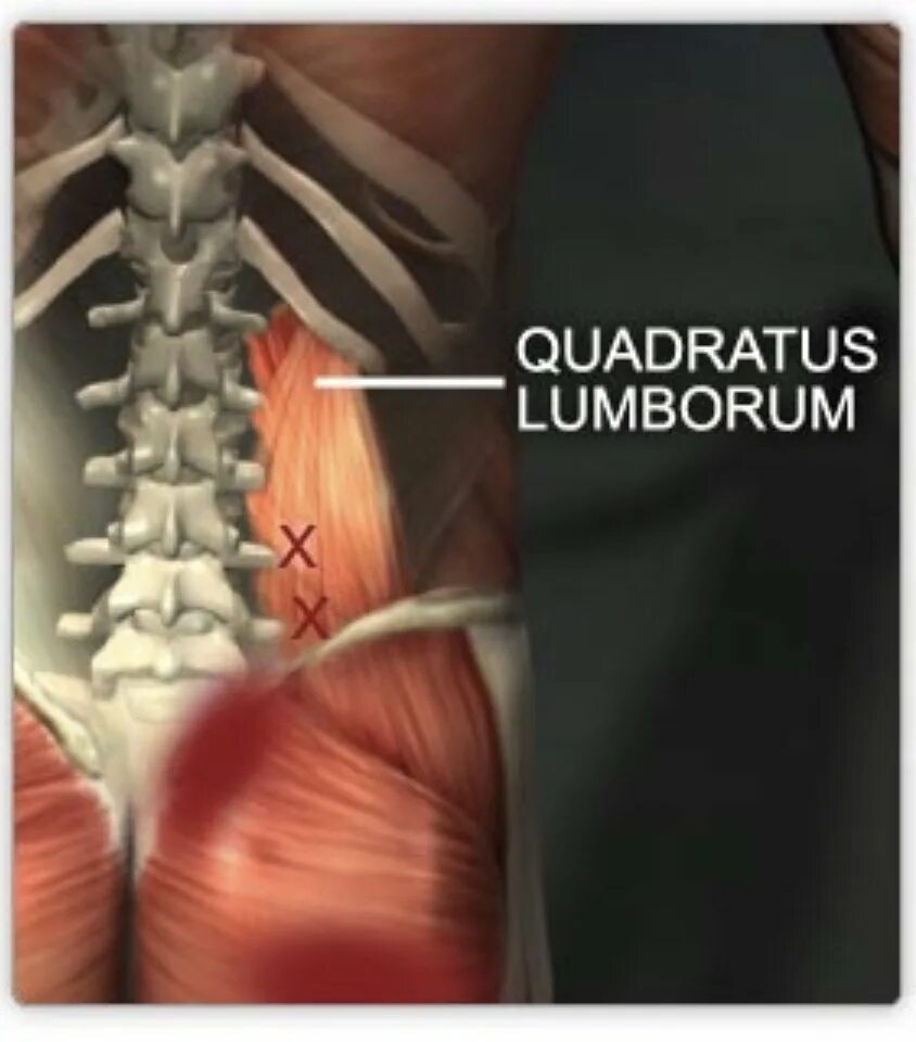 Quadratus Lumborum. Квадратная мышца поясницы триггерные точки. Синергист квадратной мышцы поясницы. Квадратная мышца поясницы мышца.