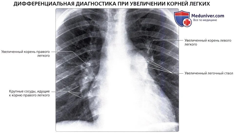 Увеличение корень легкого. Описание корня легкого на рентгенограмме. Структура корня легкого на рентгенограмме. Корень легкого анатомия рентген. Корни легких на рентгене.