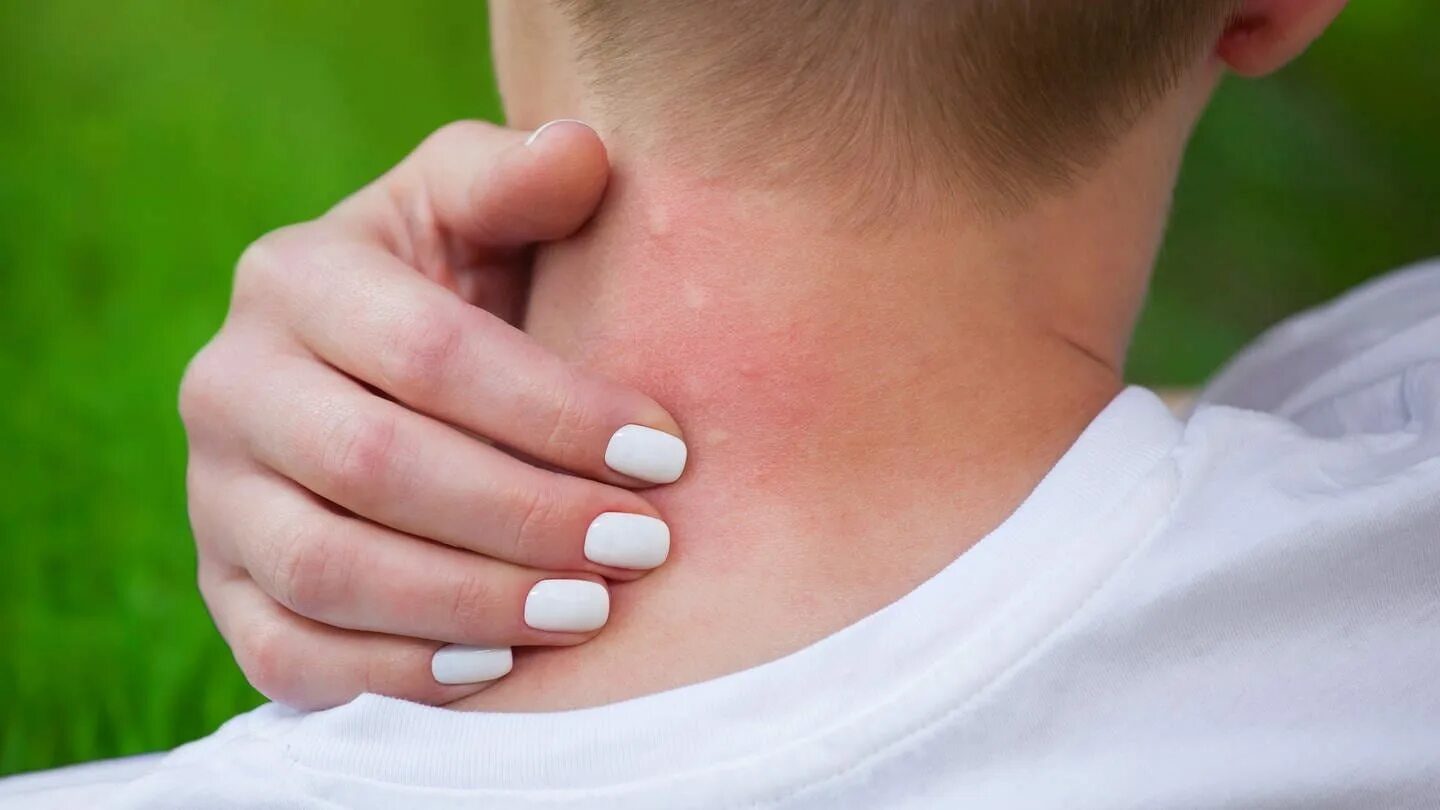 Различных местах это может быть. Аллергия на укусы насекомых на коже. Аллергическая реакция на коже. Аллергическая реакция на укус насекомого.