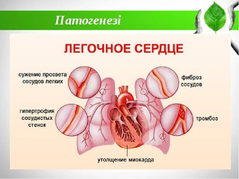 Легкие сердечные заболевания. Хроническое легочное сердце. Хроническое лёгочное се. Хроническое легочное с ердцуе.