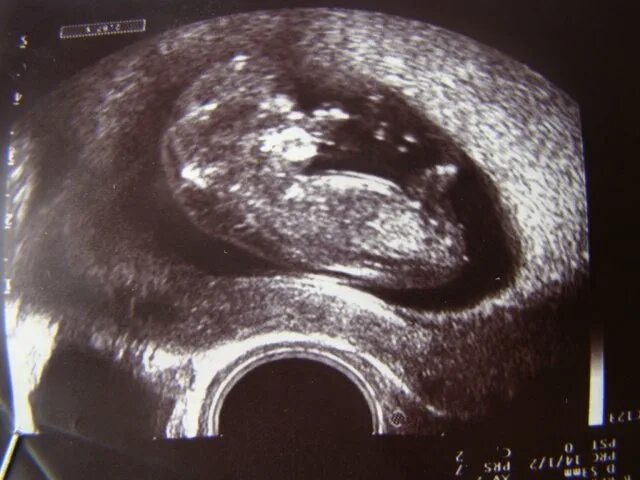 2 беременность после замершей. Неразвивающаяся беременность 8 недель.