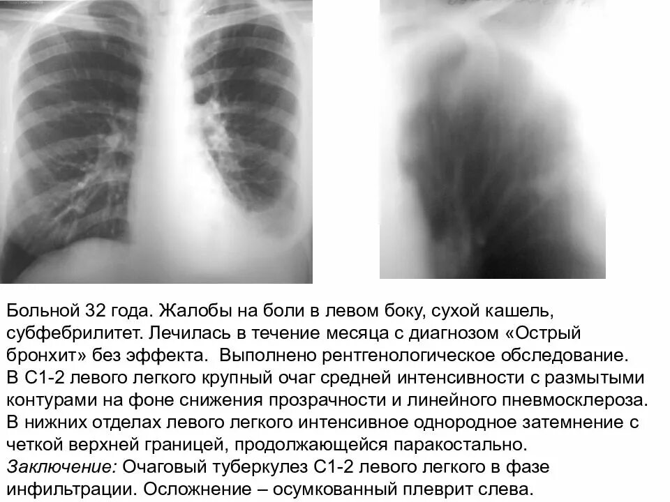 Боль в области правого легкого спереди.