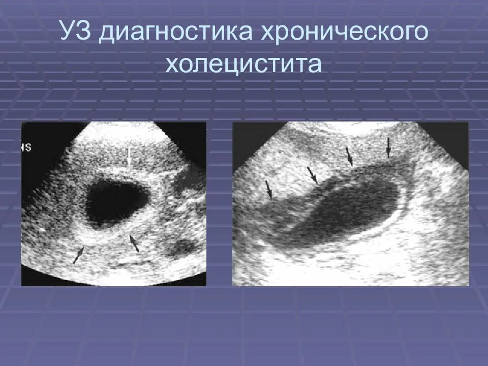 Хронический калькулезный холецистит УЗИ. Острый калькулезный холецистит на УЗИ. Хронический бескаменный холецистит УЗИ. Инструментальные исследования при остром холецистите.