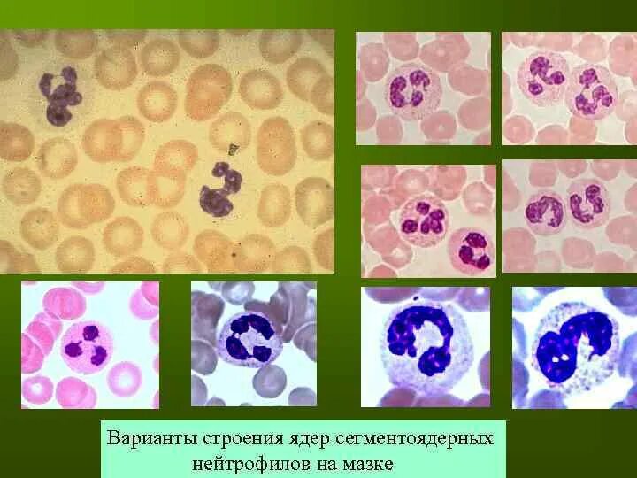 Кариопикноз это. Кариопикноз кариорексис кариолизис. Кариолизис клеток крови. Сегментоядерные нейтрофилы строение. Пикноз ядер нейтрофилов.