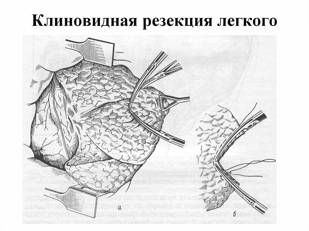 Краевая резекция пластины. Клиновидная резекция легкого методика. краевая резекция легкого. а типичная резекция лёгкого. атипичная резекция доли легкого.