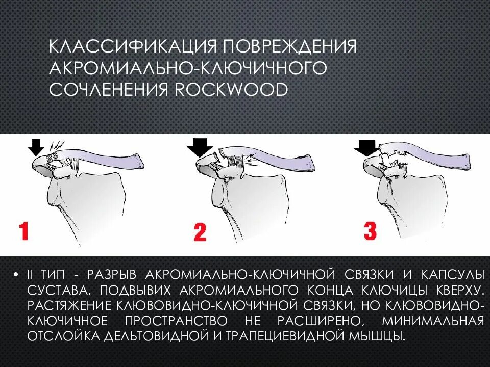 Повреждение акромиально ключичного сочленения. Разрыв связок акромиально-ключичного сочленения. Разрыв акромиально ключичного сустава рентген. Частичный разрыв ключично-акромиального сочленения. Повреждение акромиально ключичного сочленения.