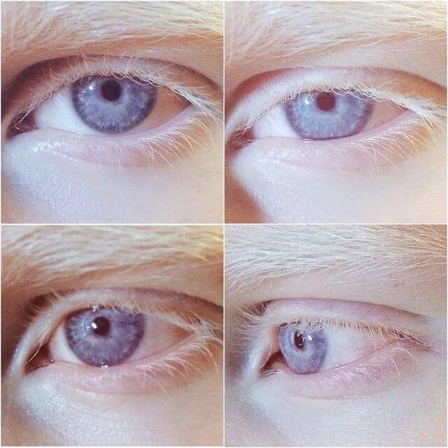 Без пигмента. Глазокожный альбинизм. Глазокожный альбинизм 1 а. Настя жидкова альбинос. Без пигмента.