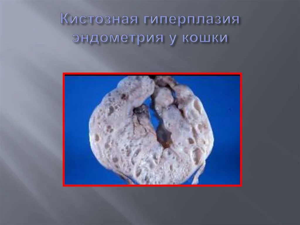 Очаги гиперплазии эндометрия. Очаги гиперплазии эндометрия. Очаги гиперплазии эндометрия. Гиперпластические процессы эндометрия классификация. Фоновые и предраковые заболевания эндометрия.