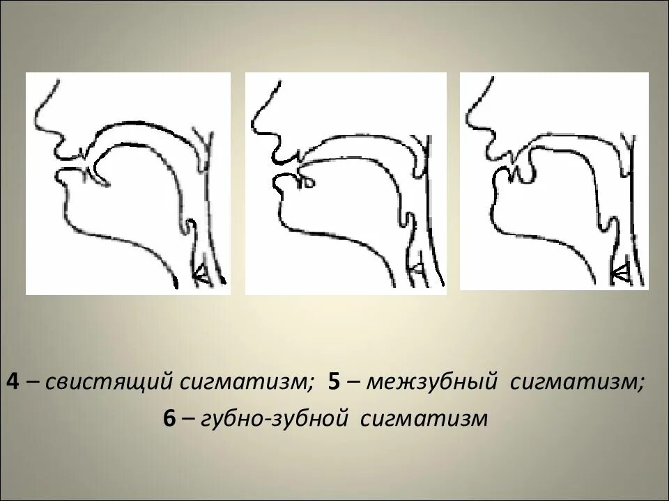 Губно-зубной сигматизм шипящих звуков. Губно зубной сигматизм звука с. Шипящий сигматизм свистящих звуков. Губно-зубной сигматизм звук ш. Расстройство речевой артикуляции