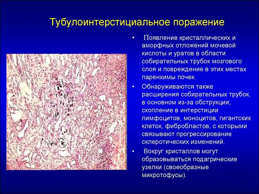 Поразить появиться. Острый нефрит патанатомия. Подагрический тофус патанатомия. Подагрическая нефропатия гистология. Подагрический нефрит гистология.
