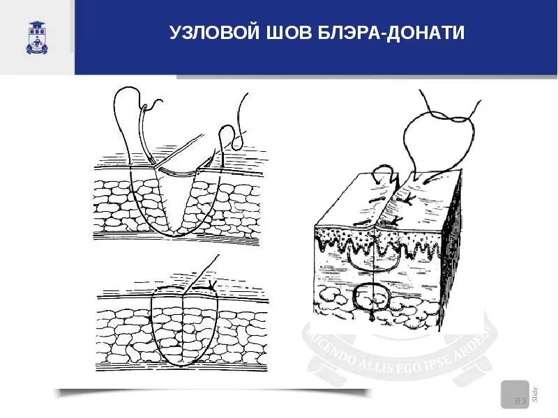 Шов по донати и альговеру. Вертикальный матрацный шов по донати. Вертикальный п образный шов. Вертикальный матрацный шов по донати. Шов по донати техника.