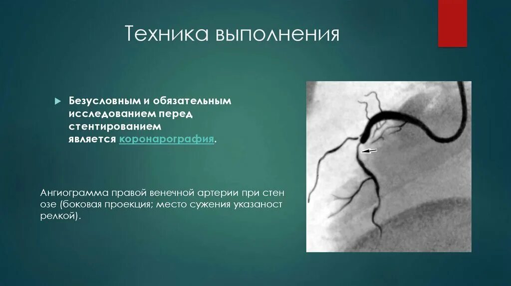 Стентирование рекомендации. Чреспищеводная коронарография. Операция стентирование коронарных артерий. Коронароангиография стентирование. Стентирование коронарных артерий показания.