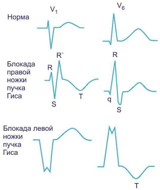 Блокада левой нужки пуска оиса. Блокада левой ножки пучка Гиса. Блок левой ножки пучка Гиса на ЭКГ. Блокада левой ножки пучка Гиса (БЛНПГ.