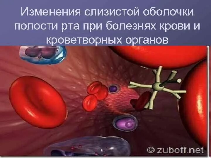 Поражения сопр при заболеваниях крови и кроветворных органов. Изменения слизистой оболочки полости рта при заболеваниях крови.