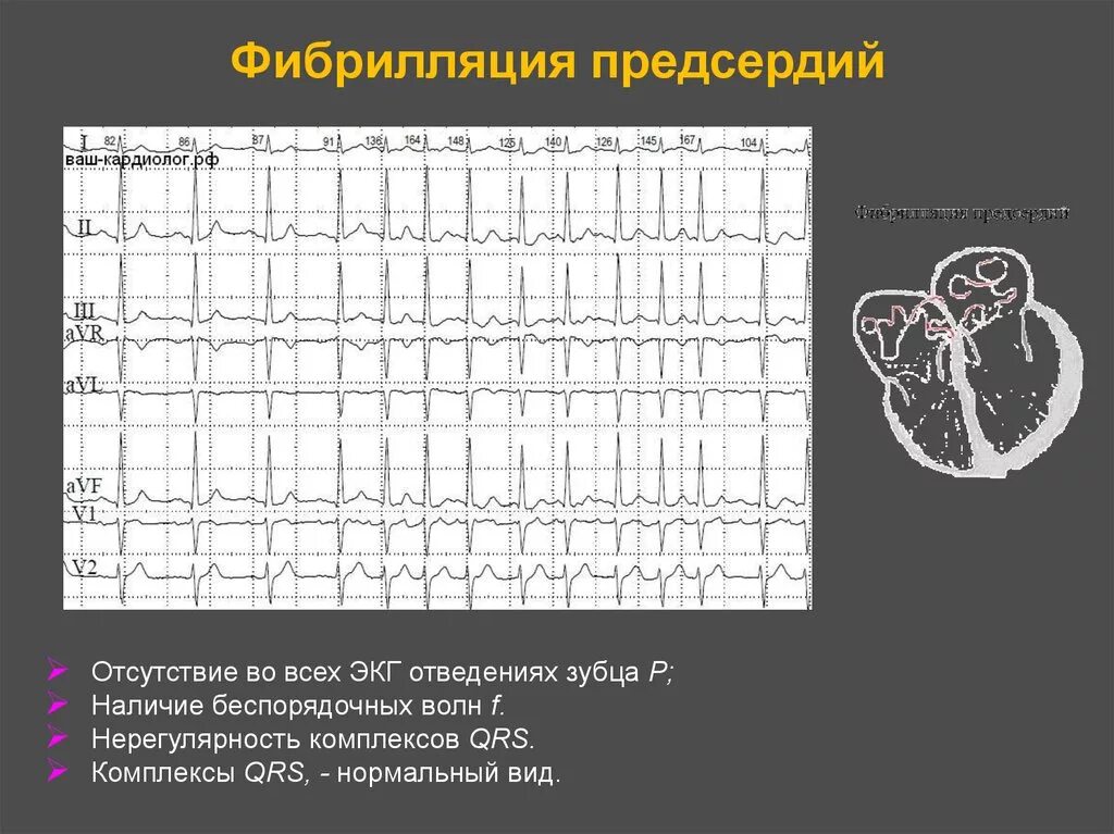 Фибрилляция и трепетание предсердий на ЭКГ. Пароксизмальная фибрилляция предсердий на ЭКГ. Фибрилляция предсердий Мерцательная аритмия ЭКГ. Фибрилляция предсердий ЭКГ тахисистолия. Предсердие болезни