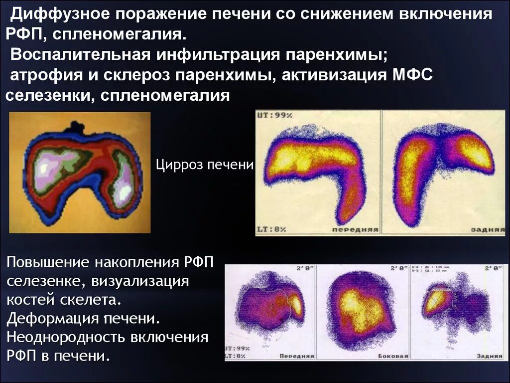 Печень диффузно неоднородная что это. Паренхима печени диффузно изменена. Поражение паренхимы печени. Паренхиматозные изменения печени. Диффузные изменения в печен.