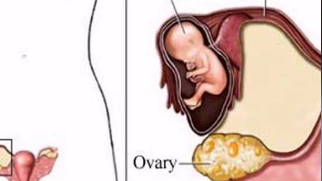 Болит яичник во время беременности. Киста яичника при беременности. Матка и яичники при беременности. Киста на яичнике при беременности на ранних. Киста правого яичника при беременности.