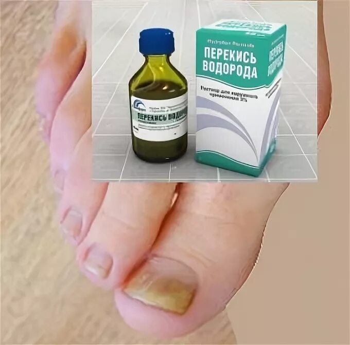 вылечил ногти от грибка. отмыть йод. крем для заусенцев на пальцах рук.