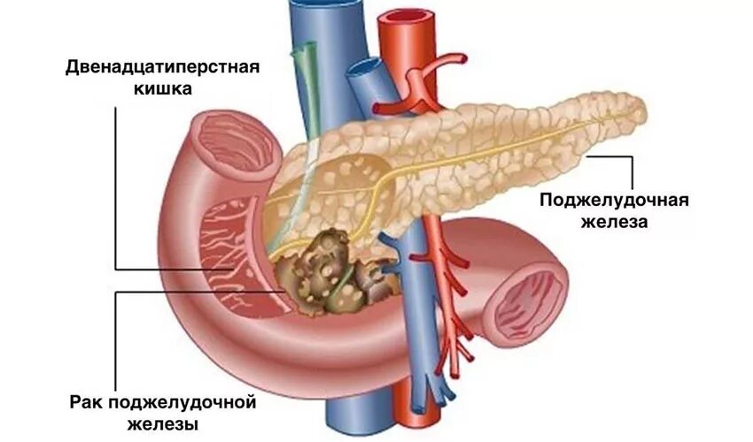 Как выглядит рак поджелудочной железы Как выглядит рак поджелудочной железы